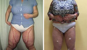 Liposuzione laser prima e dopo